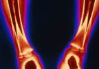 Reversing vitamin D deficiency in infants Reversing vitamin D deficiency in infants