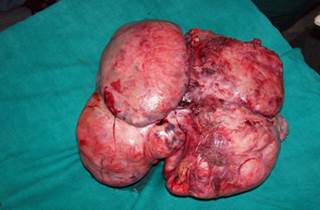 Figure 1. The nontender, immobile mass measured 21 cm. Figure 1. The nontender, immobile mass measured 21 cm.