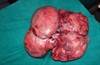 Abdominal mass in a pregnant woman forces induction Abdominal mass in a pregnant woman forces induction