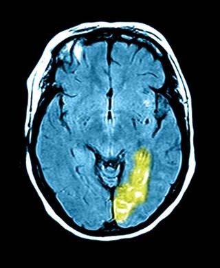 Statins, which have been found to help after ischemic strokes, may also improve outcomes of hemorrhagic strokes. Statins, which have been found to help after ischemic strokes, may also improve outcomes of hemorrhagic strokes.