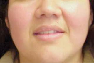 Rosacea Linked to Increased Risk of Alzheimer's Dementia Rosacea Linked to Increased Risk of Alzheimer's Dementia