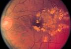 Diabetic retinopathy: diagnosis, prevention and treatment Diabetic retinopathy: diagnosis, prevention and treatment