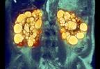 Adult polycystic kidney disease management Adult polycystic kidney disease management