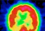 Treatment guidelines for Alzheimer-type dementia Treatment guidelines for Alzheimer-type dementia