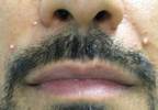 Pustular facial eruptions Pustular facial eruptions