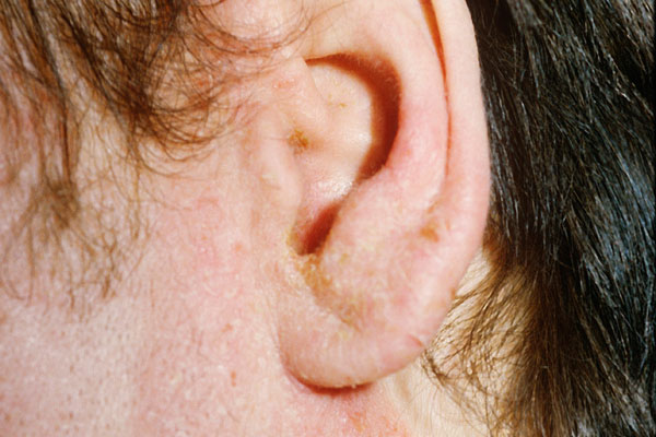 Swimmer's Ear