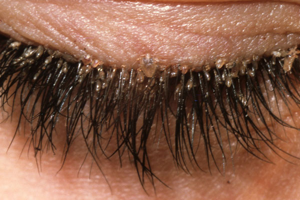 List of Synonyms and Antonyms of the Word: eyelid lice