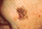 Skin cancer over- and under-recognized Skin cancer over- and under-recognized