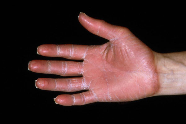 Acral erythema