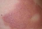 Burning rash spreads from the trunk to the rest of the body Burning rash spreads from the trunk to the rest of the body