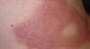 Burning rash spreads from the trunk to the rest of the body Burning rash spreads from the trunk to the rest of the body
