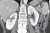 Kidney mass detected on ultrasound doubles in size over nine months Kidney mass detected on ultrasound doubles in size over nine months