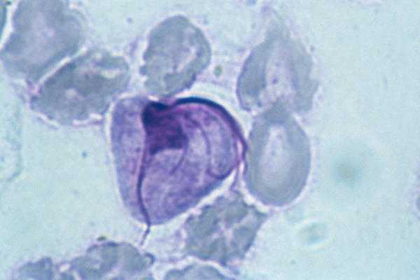 Trichomonas vaginalis prevalent in older women - The Clinical Advisor