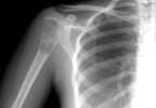 A running accident leads to the discovery of a humeral lesion A running accident leads to the discovery of a humeral lesion