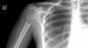 A running accident leads to the discovery of a humeral lesion A running accident leads to the discovery of a humeral lesion