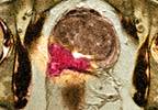 When to screen for prostate cancer When to screen for prostate cancer