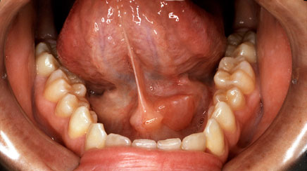 Evaluating salivary gland tumors and diseases - The 