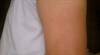 Severe headache, fever and arm rash after vaccination Severe headache, fever and arm rash after vaccination