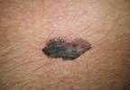 Newly developed brown papules Newly developed brown papules
