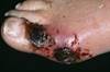 Antimicrobial Dressing For Diabetic Foot Ulcers Improve Healing Antimicrobial Dressing For Diabetic Foot Ulcers Improve Healing