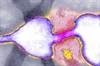 Understanding colon cancer screening tests Understanding colon cancer screening tests