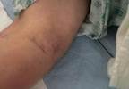 Acute onset of pain and a noncompressible area in the anterior forearm Acute onset of pain and a noncompressible area in the anterior forearm