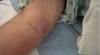Acute onset of pain and a noncompressible area in the anterior forearm Acute onset of pain and a noncompressible area in the anterior forearm