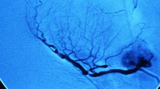 In coronary atherosclerosis, plaque narrows the diameter of the arteries. In coronary atherosclerosis, plaque narrows the diameter of the arteries.