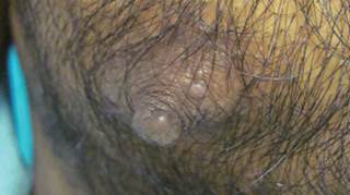 Yellow papules near the nipple Yellow papules near the nipple