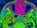Efficacy of Clinical Decision Rules in Diagnosing Acute, Bacterial Rhinosinusitis Efficacy of Clinical Decision Rules in Diagnosing Acute, Bacterial Rhinosinusitis