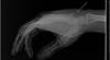 When a patient falls, the pain
indicates dislocation When a patient falls, the pain
indicates dislocation