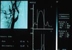 Intracranial arterial stenting plus aggressive medical management increases stroke risk Intracranial arterial stenting plus aggressive medical management increases stroke risk