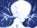 ACEi, ARB Use Improves Pulmonary Function in Emphysema ACEi, ARB Use Improves Pulmonary Function in Emphysema