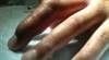 A simple case of cellulitis on the third finger is a lot more A simple case of cellulitis on the third finger is a lot more