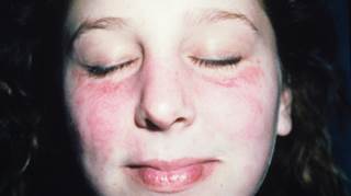 A photosensitive rash (shown) is a hallmark symptom of systemic lupus erythematosus. A photosensitive rash (shown) is a hallmark symptom of systemic lupus erythematosus.