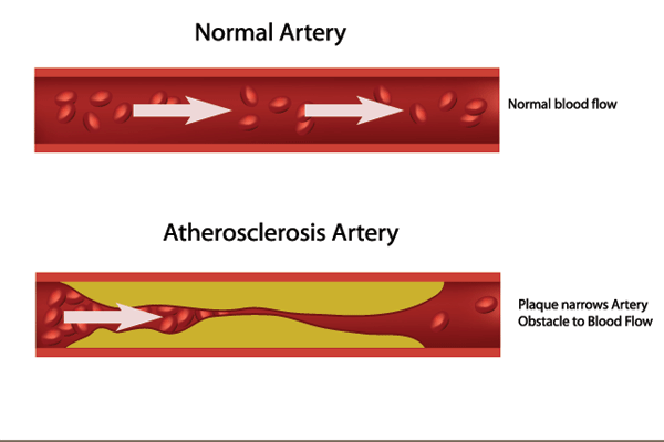 Hyperlipidemia & Coronary Heart Disease