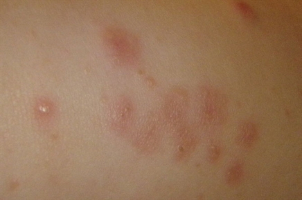 Diffuse erythematous papules - The Clinical Advisor