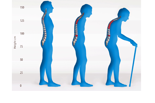 Osteoporosis Diagnosis, Prevention & Treatment