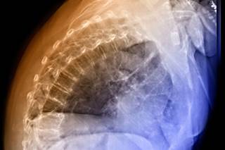 MRI reduces vertebral compression fracture misdiagnoses before cementing MRI reduces vertebral compression fracture misdiagnoses before cementing