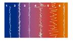 Sleep Disturbances in Fibromyalgia Distinct From Primary Insomnia Sleep Disturbances in Fibromyalgia Distinct From Primary Insomnia