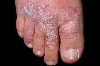 Plaque psoriasis Plaque psoriasis