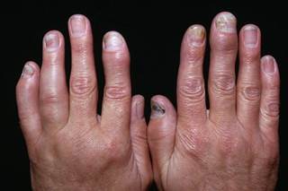 Screening tools aid in psoriatic arthritis diagnosis Screening tools aid in psoriatic arthritis diagnosis