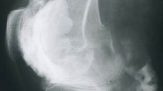 Rituximab retreatment at clinical relapse is at least as cost-effective as a more intensive regimen in longstanding RA. Rituximab retreatment at clinical relapse is at least as cost-effective as a more intensive regimen in longstanding RA.