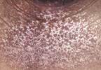 Decreasing Morbidity Associated With Scleroderma By Addressing Pain Management Decreasing Morbidity Associated With Scleroderma By Addressing Pain Management