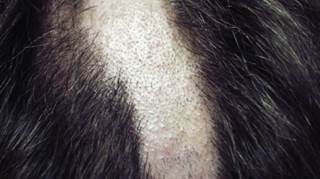 The French dermatologist Francois Hallopeau first coined the term “trichotillomania," which means “hair pulling insanity,” in 1889. The French dermatologist Francois Hallopeau first coined the term “trichotillomania," which means “hair pulling insanity,” in 1889.
