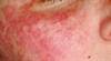 Case Study: Headache, Confusion, and Seizures in Patient With SLE Case Study: Headache, Confusion, and Seizures in Patient With SLE