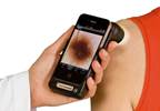 Smartphone apps screen for melanoma Smartphone apps screen for melanoma