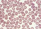Tick-borne disease looks like the flu Tick-borne disease looks like the flu