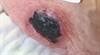 Painful skin ulcer develops in older woman on dialysis Painful skin ulcer develops in older woman on dialysis