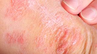 Diabetes risk increases with psoriasis severity Diabetes risk increases with psoriasis severity